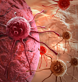 Злокачественная опухоль (Рак) — причины, симптомы, виды и лечение рака